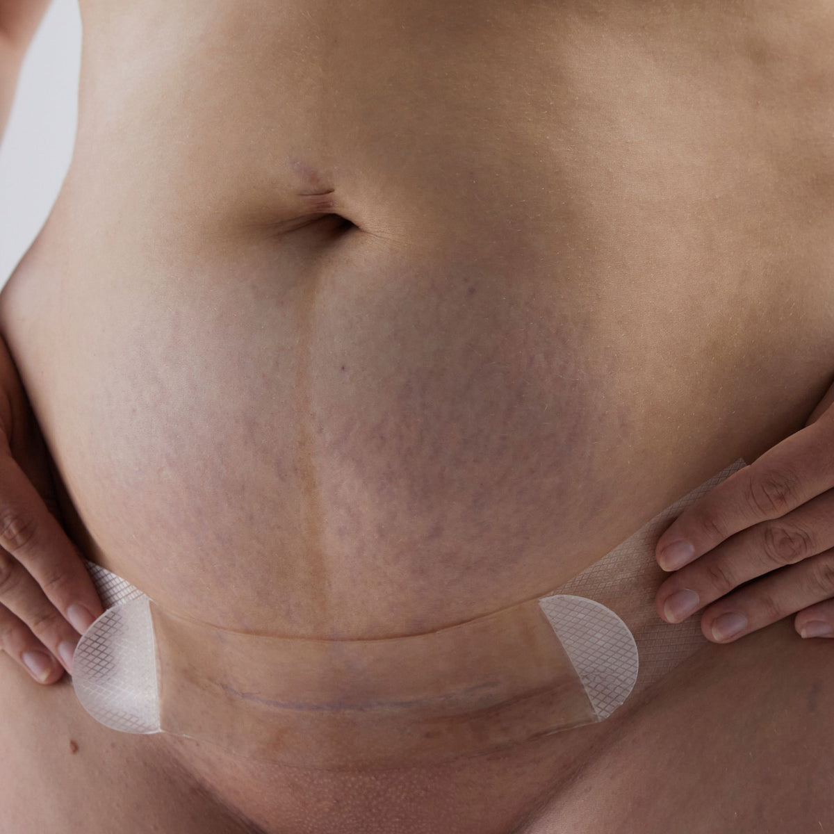 Bare Mum | Postpartum Care | Silicone Gel Scar Strips | C-Section Recovery